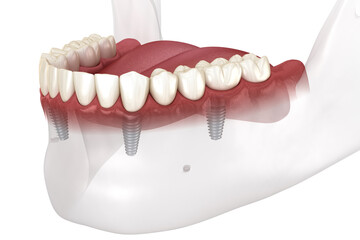 Dental prosthesis supported by 4 implants, screw fixation. 3D illustration