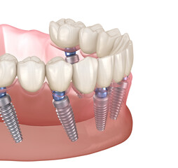 Mandibular prosthesis on 6 system supported by implants, screw fixation. 3D illustration