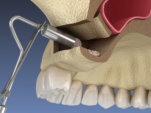 Sinus Lift Surgery - Adding artificial new bone. 3D illustration