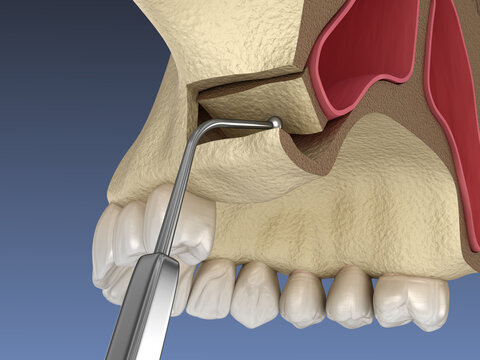 Sinus Lift Surgery - Creating side access to the Sinus. 3D illustration