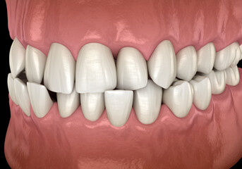 Abnormal teeth position, dental orthodontic.3D illustration