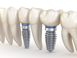 Dental Implants. 3D illustration concept of human teeth