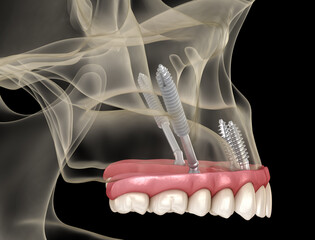 Maxillary prosthesis supported by zygomatic implants. Medically accurate 3D illustration of human teeth and dentures
