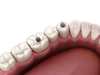 Premolar and Molar tooth crown installation over implant, screw fixation. 3D illustration of dental treatment