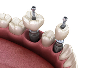 Premolar and Molar tooth crown installation over implant, screw fixation. 3D illustration of dental treatment