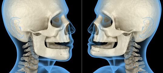 Mandibular Jaw, bone recession after losing teeth. Вental 3D illustration