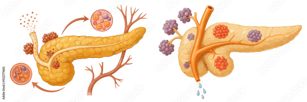 Poster explaining pancreatic function and disease through detailed illustrations of exocrine and endocrine 