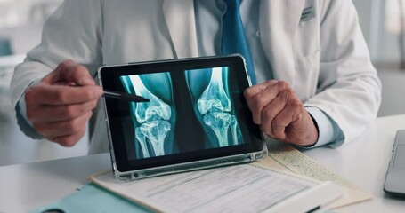 Doctor, hands and tablet for x ray with screen, knee and osteoporosis with point at hospital. People, application and medical consultation for arthritis, feedback and report for wellness at clinic - Powered by Adobe