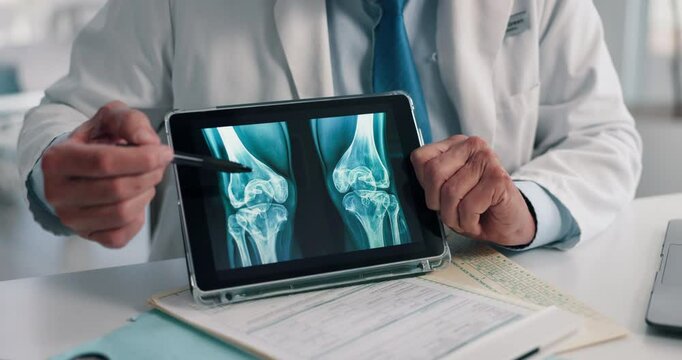 Doctor, hands and tablet for x ray with screen, knee and osteoporosis with point at hospital. People, application and medical consultation for arthritis, feedback and report for wellness at clinic - Powered by Adobe