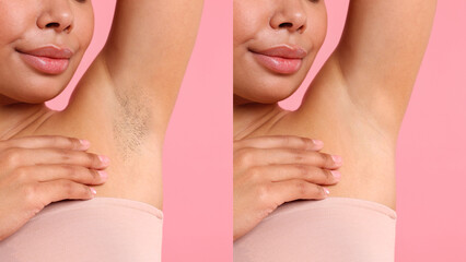 Before and after epilation. Woman showing armpit on pink background, closeup. Collage