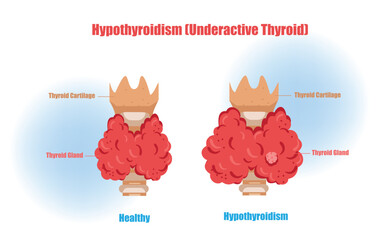 Anatomy of Hypothyroidism Underactive Thyroid