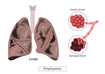 Emphysema is a chronic lung condition