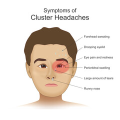 Cluster Headaches its symptoms