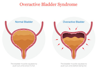 Illustration of Overactive Bladder Disorder and Effects
