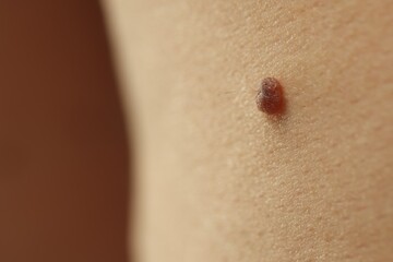 Man with mole on his skin against brown background, closeup. Space for text