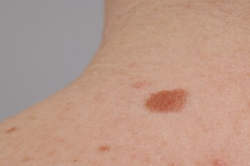 Woman with moles on her body against light background, closeup