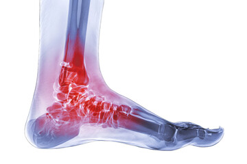 X-ray of an injured ankle and foot, highlighted with red