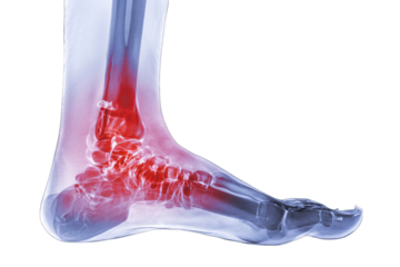 X-ray of an injured ankle and foot, highlighted with red