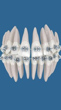 Abnormal teeth position correction with metal braces tretament. Medically accurate dental 3D animation