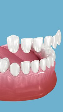Dental veneer placement over frontal teeth. 3D Animation