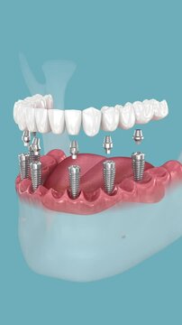 Mandibular prosthesis fixation over six implants. Medically accurate 3D animation