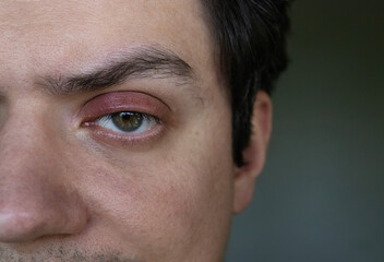 Obraz premium Close-up image of human eye with signs of inflammation. Swollen eyelid due to stye or blepharitis.
