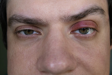 Man suffering from upper eyelid swelling and redness. Common symptom of stye, blepharitis or...