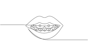 Continuous line drawing of braces for teeth. Vector illustration as line art outline, One continuous drawing of dental aligners. Dental care. Vector illustration.