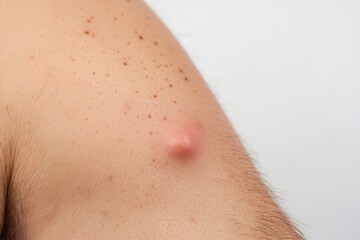 Close-up view of a skin lesion on the upper arm.