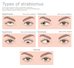Four types of strabismus and normal human eyes. Vector illustration, medical series. 