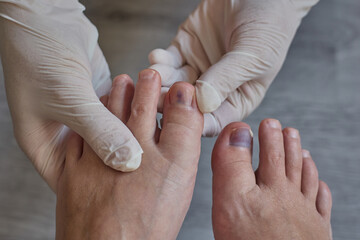 Toenail with fungal infection or damage, close up of nail health problems, nail fungus