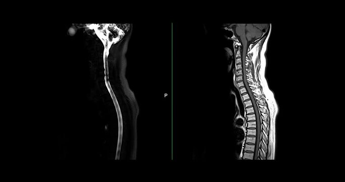 MRI Screening whole spine  sagittal T2  FS showing  spine compress spinal cord ( Myelopathy )