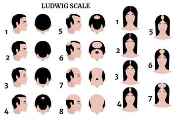 Ludwig scale illustration showing stages of hair loss in men and women. Baldness progression diagram, male and female pattern hair loss chart, front and top view, medical reference image