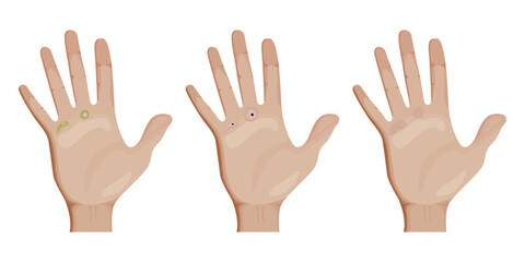 Callus and corn removal showing different stages of healing