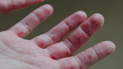Understanding different skin conditions on hands with rashes and lesions