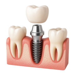 A tooth with a silver screw in it is shown with a pink background. The tooth is missing a portion of its root, and the screw is inserted into the bone to replace it. Concept of dental health