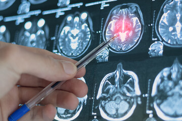 CT scan image of human brain. Mri or x-ray scan for diagnostic human head diseases.