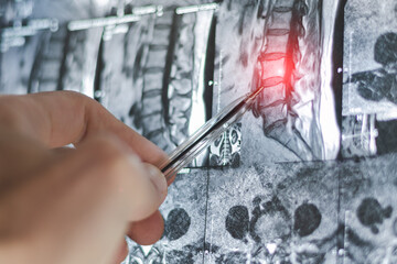 X-ray of lumbar and thoracic hernias on human spine. Mri of diseases.