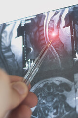 Vertical X-ray of lumbar and thoracic hernias on human spine. Mri of diseases.