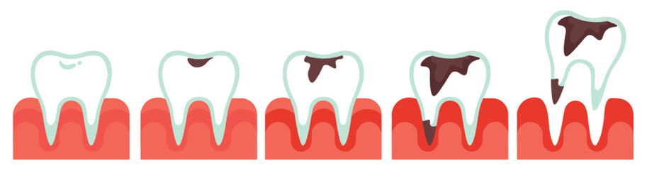 A healthy tooth, a tooth with caries. Stages of tooth caries development from healthy teeth and gums to tooth loss