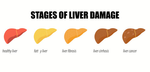 Stages of nonalcoholic liver damage. Medical infographic of Liver Disease