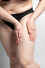 Woman compressing the skin on her legs checking for cellulite and excess subcutaneous fat. A woman showing her stretch marks on her hips. Female thighs with stretch marks on the skin.