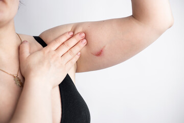 Female hand with thermal burn of the skin. Domestic injury during ironing or cooking. Scars on the...