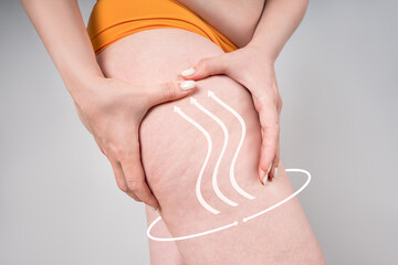 Legs liposuction, fat and cellulite removal concept, overweight female body with painted surgical...
