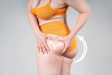 Legs and buttocks liposuction, fat and cellulite removal concept, overweight female body with...