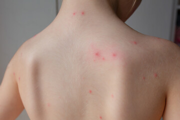 Naklejka premium Little girl with chickenpox playing at home, quarantine isolation during illness, varicella zoster virus or chickenpox blister rash.
