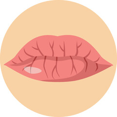 Dry and Cracked Lips Vector Concept Illustration. Cosmetic problem of dryness and dehydration of the mouth 
