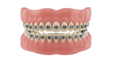 Examining Dental Braces and Teeth Model for Orthodontic Treatment