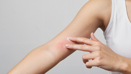 Effective Ways a Woman Applying Cream to Rash Can Find Relief Soothing Irritated Skin