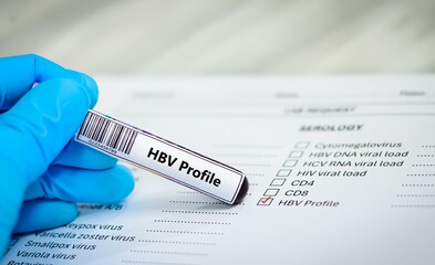 Blood sample tube and paper reqeust order for HBV profile test analysis.